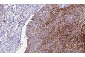 ABIN6276972 at 1/100 staining Human urothelial cancer tissue by IHC-P. (CD27 Antikörper  (Internal Region))