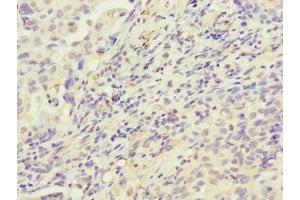 Immunohistochemistry of paraffin-embedded human lung cancer using ABIN7155154 at dilution of 1:100 (HK3 Antikörper  (AA 1-270))
