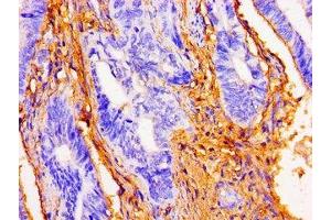 Immunohistochemistry of paraffin-embedded human colon cancer using ABIN7149775 at dilution of 1:100 (Desmoglein 1 Antikörper  (AA 384-539))