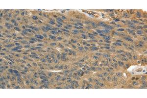 Immunohistochemistry of paraffin-embedded Human ovarian cancer using MSN Polyclonal Antibody at dilution of 1:30 (Moesin Antikörper)