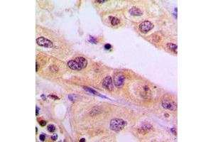 Immunohistochemical analysis of CYB5R3 staining in human liver cancer formalin fixed paraffin embedded tissue section. (CYB5R3 Antikörper  (Center))