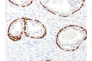 Formalin-fixed, paraffin-embedded human Prostate Cancer stained with p63 Rabbit Polyclonal Antibody.
