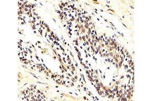 IHC analysis of FFPE human prostate carcinoma section using AKT1/2/3 antibody; Ab was diluted at 1:25. (AKT 1/2/3 Antikörper  (AA 278-312))