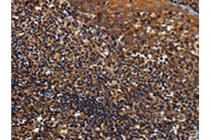 The image on the left is immunohistochemistry of paraffin-embedded Human tonsil tissue using ABIN7129963(KCNK17 Antibody) at dilution 1/60, on the right is treated with fusion protein. (KCNK17 Antikörper)