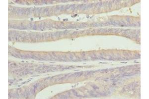 Immunohistochemistry of paraffin-embedded human endometrial cancer using ABIN7146874 at dilution of 1:100 (CSNK1G1 Antikörper  (Isoform gamma 1))