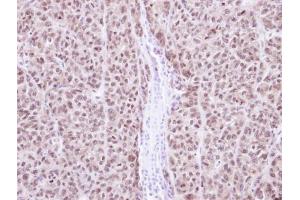 IHC-P Image Immunohistochemical analysis of paraffin-embedded DLD1 Xenograft, using RAG2, antibody at 1:100 dilution. (RAG2 Antikörper  (Center))