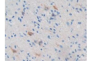 IHC-P analysis of Human Glioma Tissue, with DAB staining. (PRKAB2 Antikörper  (AA 17-260))