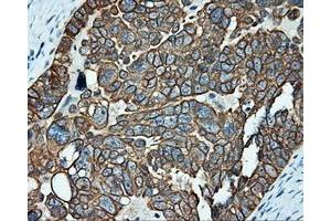 Immunohistochemical staining of paraffin-embedded Adenocarcinoma of breast tissue using anti-SRR mouse monoclonal antibody. (SRR Antikörper)