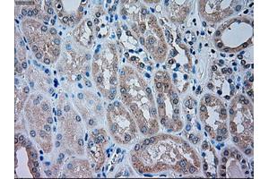 Immunohistochemical staining of paraffin-embedded Carcinoma of liver tissue using anti-TRPM4mouse monoclonal antibody. (TRPM4 Antikörper)