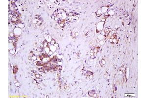 Formalin-fixed and paraffin embedded human colon carcinoma labeled with Rabbit Anti-IL-17RC/IL-17RL Polyclonal Antibody, Unconjugated (ABIN747923) at 1:200 followed by conjugation to the secondary antibody and DAB staining.