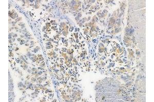 ABIN6260320 and ABIN6272259 at 1/100 staining human lung squamous cell carcinoma by IHC-P. (BTBD6 Antikörper  (Internal Region))