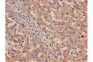 Immunohistochemistry of paraffin-embedded human liver cancer using ABIN7156456 at dilution of 1:100 (Integrin Alpha2b Antikörper  (AA 639-887))