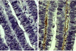 Paraffin embedded human gastric cancer tissue was stained with Goat IgG-UNLB isotype control, DAB, and hematoxylin. (Collagen Type V Antikörper  (Biotin))