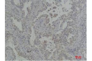 Immunohistochemistry (IHC) analysis of paraffin-embedded Human Lung Carcinoma using Bcl-XlRabbit Polyclonal Antibody diluted at 1:200. (BCL2L1 Antikörper)