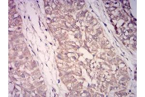 Immunohistochemical analysis of paraffin-embedded bladder cancer tissues using WDFY3 mouse mAb with DAB staining. (WDFY3 Antikörper  (AA 3277-3526))