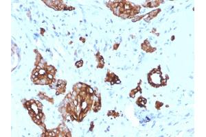Formalin-fixed, paraffin-embedded human Breast Carcinoma stained with Cytokeratin-7 Mouse Monoclonal Antibody (KRT7/2200). (Cytokeratin 7 Antikörper)