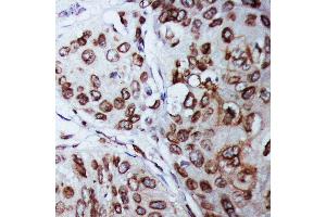 Anti-Lamin B1 antibody, IHC(P) IHC(P): Human Mammary Cancer Tissue