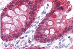 Human Colon (formalin-fixed, paraffin-embedded) stained with CA2 antibody ABIN214579 at 5 ug/ml followed by biotinylated goat anti-rabbit IgG secondary antibody ABIN481713, alkaline phosphatase-streptavidin and chromogen. (CA2 Antikörper)