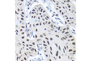 Immunohistochemistry of paraffin-embedded human lung cancer using SMN1 Rabbit mAb (ABIN7270651) at dilution of 1:100 (40x lens).