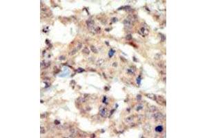 Formalin-fixed and paraffin-embedded human cancer tissue reacted with the primary antibody, which was peroxidase-conjugated to the secondary antibody, followed by DAB staining. (EPH Receptor B6 Antikörper  (N-Term))