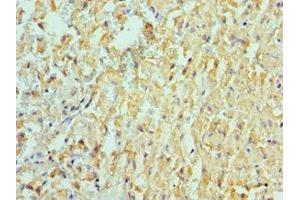 Immunohistochemistry of paraffin-embedded human liver cancer using ABIN7150066 at dilution of 1:100 (ADAM9 Antikörper  (AA 475-685))