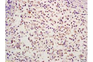 Formalin-fixed and paraffin embedded human colon carcinoma labeled with Anti-HMGB4 Polyclonal Antibody, Unconjugated (ABIN734918) at 1:200 followed by conjugation to the secondary antibody and DAB stainin (HMGB4 Antikörper  (AA 31-130))