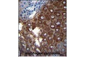 P1 Antibody (Center) (ABIN655817 and ABIN2845241) iunohistochemistry analysis in formalin fixed and paraffin embedded human esophageal carcinoma followed by peroxidase conjugation of the secondary antibody and DAB staining. (MMP1 Antikörper  (AA 317-347))