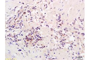 Formalin-fixed and paraffin embedded human colon carcinoma labeled with Rabbit Anti AADAC Polyclonal Antibody, Unconjugated (ABIN1387867) at 1:200 followed by conjugation to the secondary antibody and DAB staining