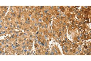 Immunohistochemistry of paraffin-embedded Human liver cancer tissue using ANXA9 Polyclonal Antibody at dilution 1:30 (Annexin A9 Antikörper)