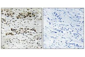 Immunohistochemical analysis of paraffin-embedded human breast carcinoma tissue using Estrogen Receptor-α (Phospho-Ser102) antibody (left)or the same antibody preincubated with blocking peptide (right).