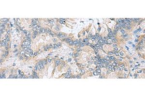 Immunohistochemistry of paraffin-embedded Human lung cancer tissue using TAGLN3 Polyclonal Antibody at dilution of 1:70(x200)