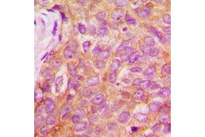 Immunohistochemical analysis of IRS1 (pS1101) staining in human breast cancer formalin fixed paraffin embedded tissue section. (IRS1 Antikörper  (C-Term, pSer1101))