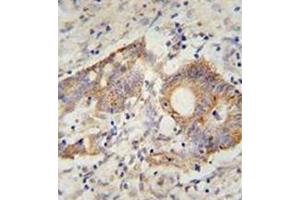 Immunohistochemistry analysis in formalin fixed and paraffin embedded human colon carcinoma reacted with AP52042PU-N, which was peroxidase conjugated to the secondary antibody and followed by DAB staining. (HHLA2 Antikörper  (N-Term))