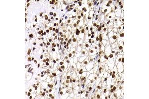Immunohistochemistry of paraffin-embedded human well-differentiated squamous skin carcinoma using PHIP antibody at dilution of 1:100 (40x lens). (PHIP Antikörper)