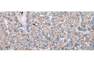 Immunohistochemistry of paraffin-embedded Human liver cancer tissue using FKBPL Polyclonal Antibody at dilution of 1:50(x200) (FKBPL Antikörper)