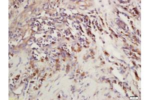 Formalin-fixed and paraffin embedded human laryngeal carcinoma labeled with Rabbit Anti-CEP120 Polyclonal Antibody, Unconjugated (ABIN2172950) at 1:200 followed by conjugation to the secondary antibody and DAB staining (CEP120 Antikörper  (AA 351-450))