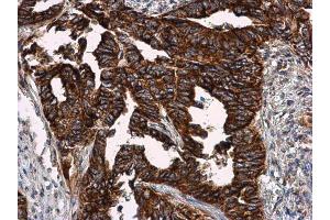 IHC-P Image VCAM1 / CD106 antibody detects VCAM1 / CD106 protein at cell membrane in human cervical carcinoma by immunohistochemical analysis. (VCAM1 Antikörper)