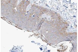 ABIN6267550 at 1/100 staining human Skin carcinoma tissue sections by IHC-P.