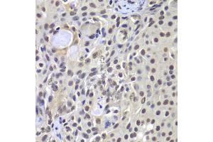 Immunohistochemistry of paraffin-embedded human well-differentiated squamous skin carcinoma using PRKDC antibody (ABIN5975861) at dilution of 1/100 (40x lens). (PRKDC Antikörper)