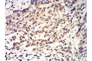 Immunohistochemical analysis of paraffin-embedded breast cancer tissues using ROP1 mouse mAb with DAB staining.