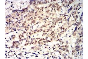 Immunohistochemical analysis of paraffin-embedded breast cancer tissues using ROP1 mouse mAb with DAB staining. (ROP1 (AA 42-183) Antikörper)