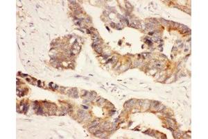 IHC-P: HSP90 antibody testing of human intestinal cancer tissue (HSP90AA1 Antikörper  (AA 2-365))