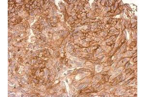 IHC-P Image ADAMTSL2 antibody [C3], C-term detects ADAMTSL2 protein at cytosol(secreted) on SkHep1xenograft by immunohistochemical analysis. (ADAMTSL2 Antikörper  (C-Term))