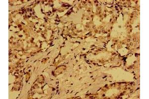 Immunohistochemistry of paraffin-embedded human breast cancer using ABIN7164808 at dilution of 1:100 (Motilin Antikörper  (AA 26-115))