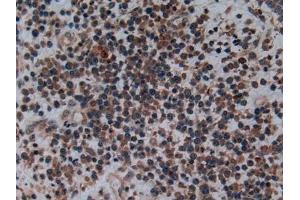 Detection of C2CD3 in Human Skin cancer Tissue using Polyclonal Antibody to C2 Calcium Dependent Domain Containing Protein 3 (C2CD3) (C2CD3 Antikörper  (AA 1432-1647))