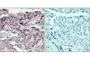 Immunohistochemistry analysis of paraffin-embedded human breast carcinoma, using JAK2 (Phospho-Tyr221) Antibody. (JAK2 Antikörper  (pTyr221))