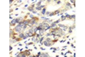 Immunohistochemistry of paraffin-embedded Human colon carcinoma using APLP1 Polyclonal Antibody at dilution of 1:100 (40x lens). (APLP1 Antikörper)