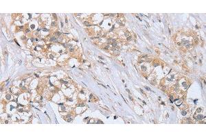 Immunohistochemistry of paraffin-embedded Human breast cancer tissue using PTPN4 Polyclonal Antibody at dilution 1:40