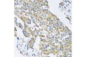 Immunohistochemistry of paraffin-embedded human lung cancer using SLC25A13 antibody. (slc25a13 Antikörper  (AA 1-300))