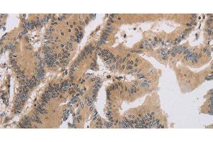 Immunohistochemistry of paraffin-embedded Human colon cancer tissue using ITIH1 Polyclonal Antibody at dilution of 1:30 (ITIH1 Antikörper)